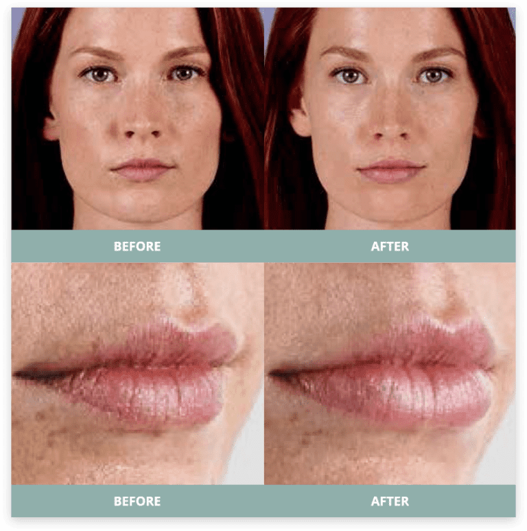 Juvederm in Charlotte, NC Voci Med Spa