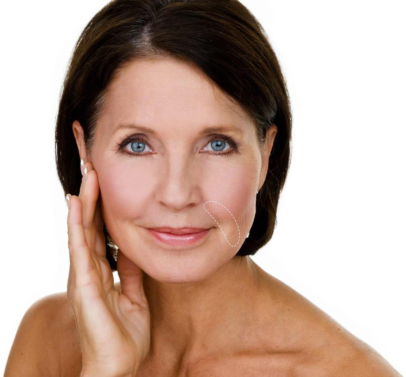 DiagramJuvederm